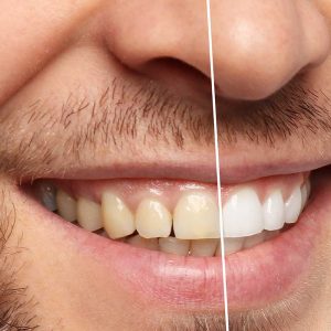 Teeth Whitening: Dental Health And Care