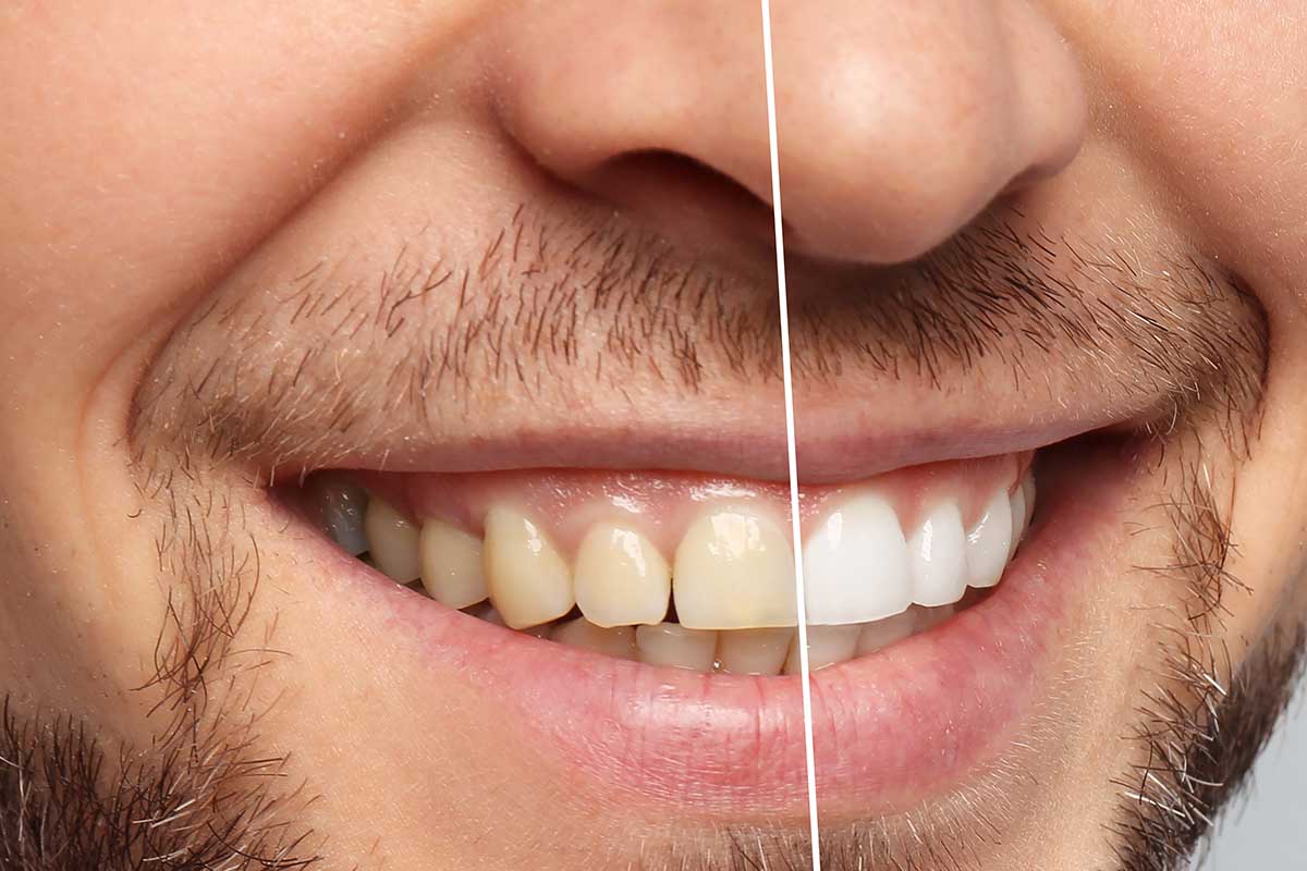 Teeth Whitening: Dental Health And Care
