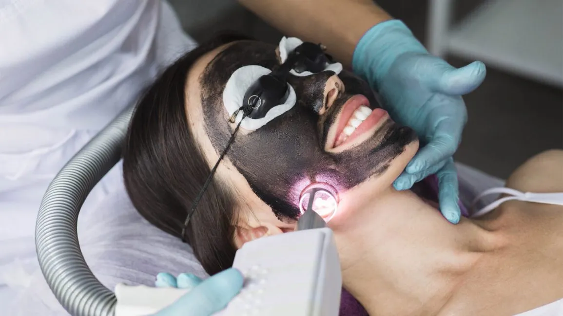 Carbon laser Peel treatment