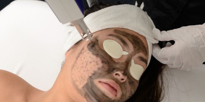 Carbon laser Peel treatment